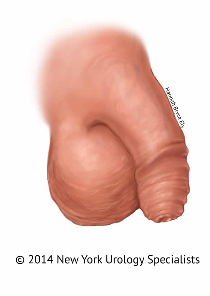 Circumcised Penis 100