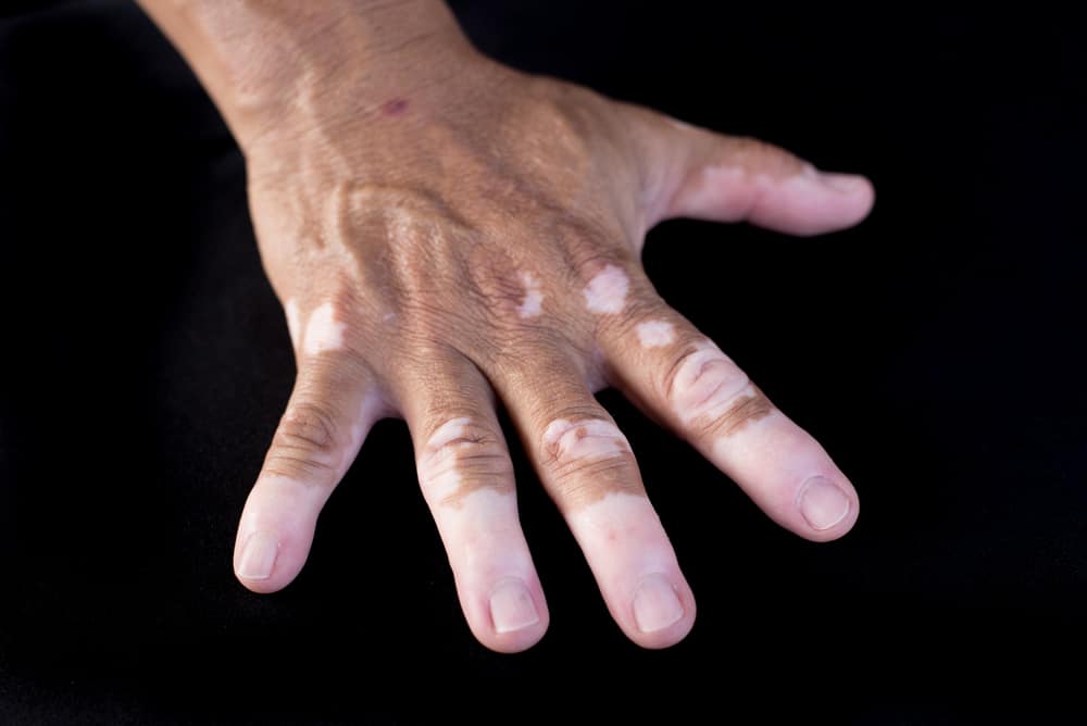 Vitiligo Of Penis 96