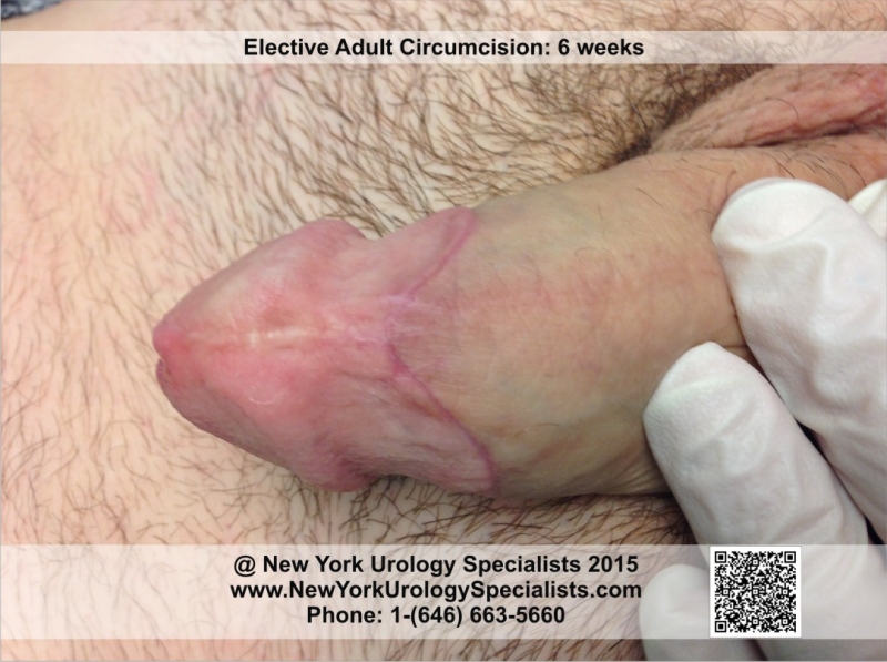 Adult Circumcised 53