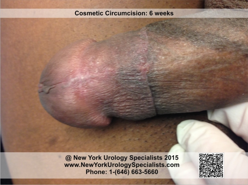 Adult Uncircumcised 46