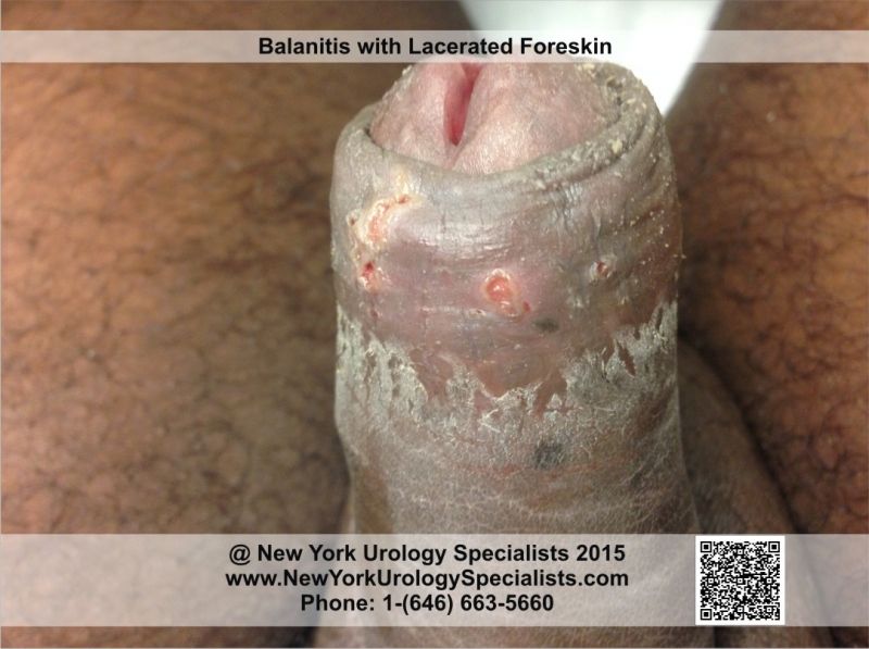 adult balanoposthitis adult balanoposthitis