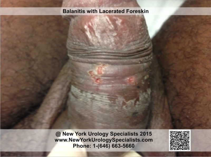 adult balanoposthitis adult balanoposthitis