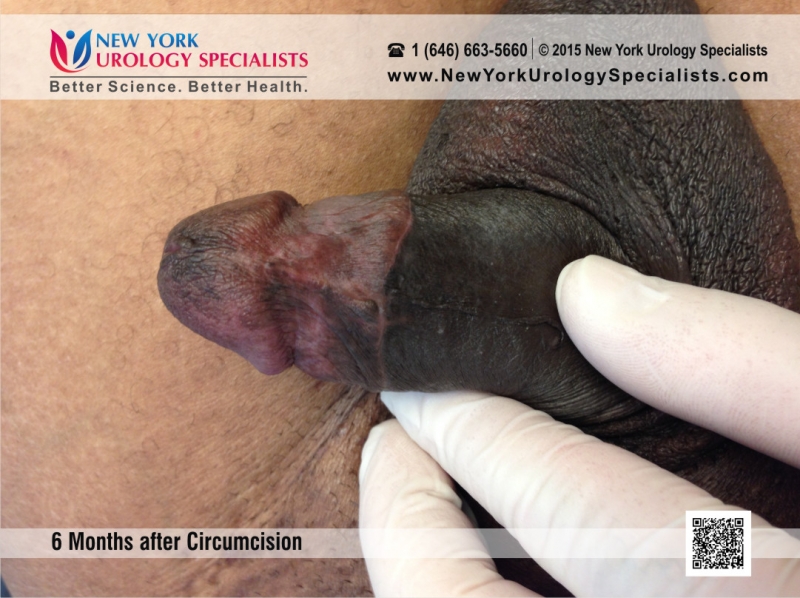 Adult Circumcision Before And After 28