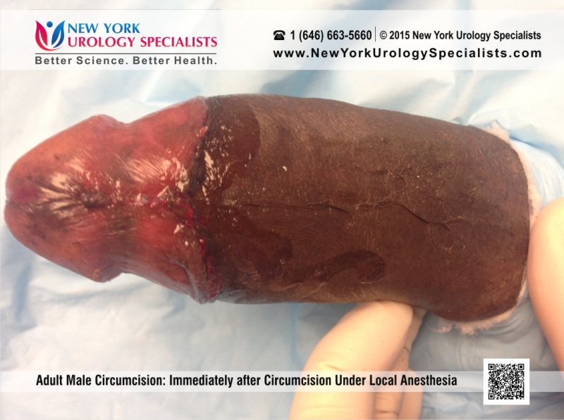 Adult Circumcision Before And After 30