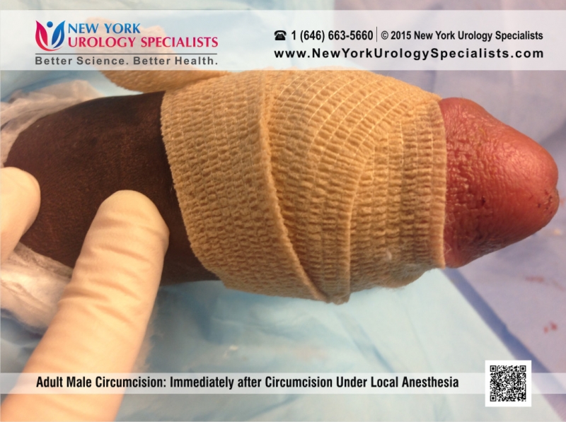 Adult Circumcision Before And After 6