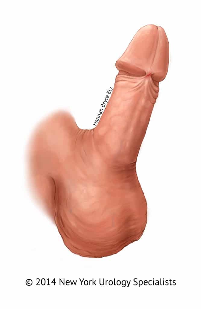 Penis Frenulum Tear 40