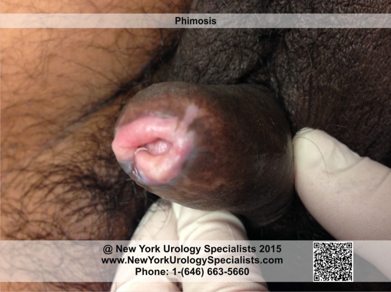 Remarkable, phimosis in adults happens. consider Very phimosis in adults agree with