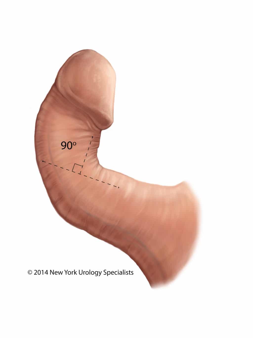 Peroni Penis 114
