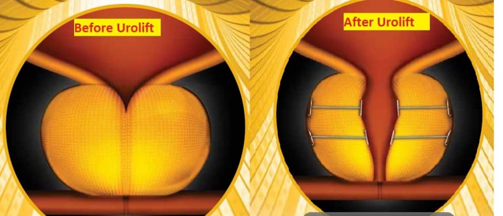 Urolift for Enlarged Prostate New Treatment Option for