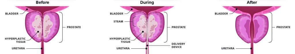 Rezum Procedure