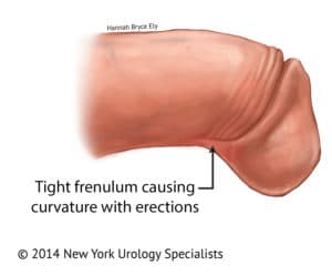 Tight frenulum causing curvature with erections