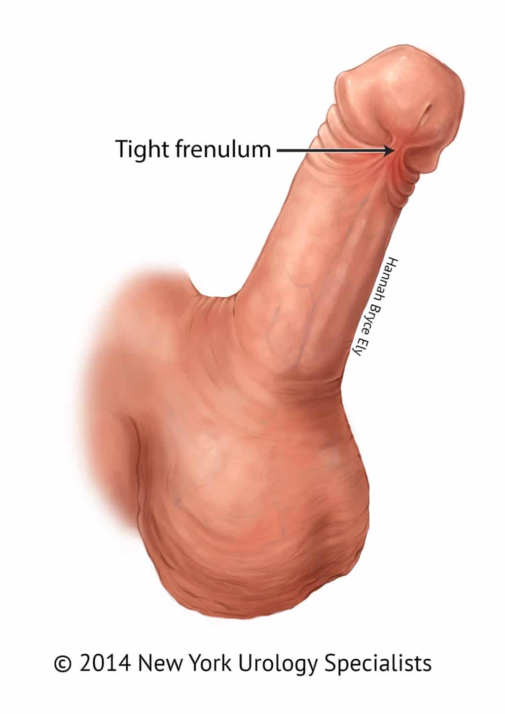 Frenillo Corto O Tirante Del Pene Adult Circumcision In Nyc