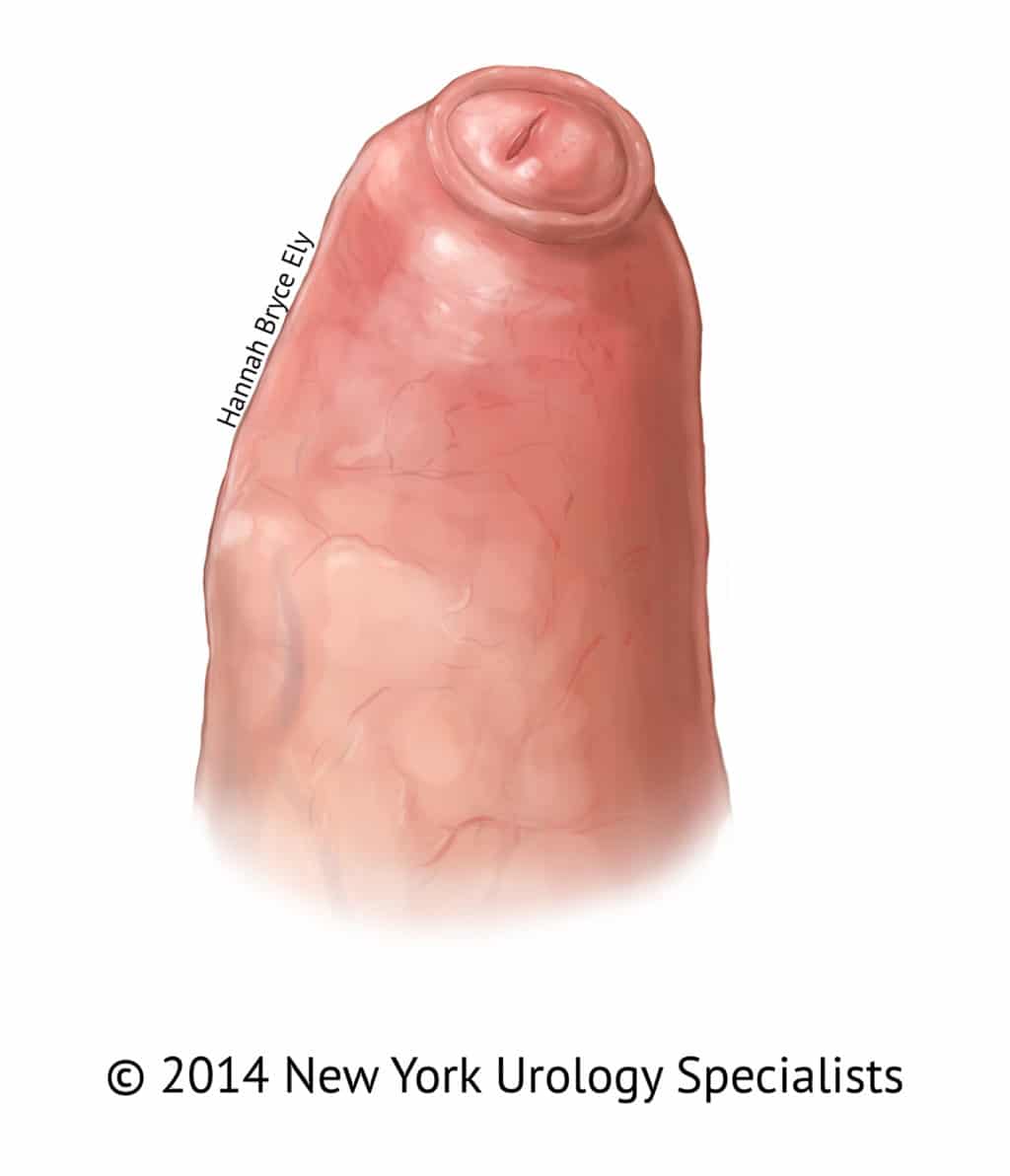Лечение фимоза: специалисты по обрезанию в Нью-Йорке - Adult Circumcision  in NYC