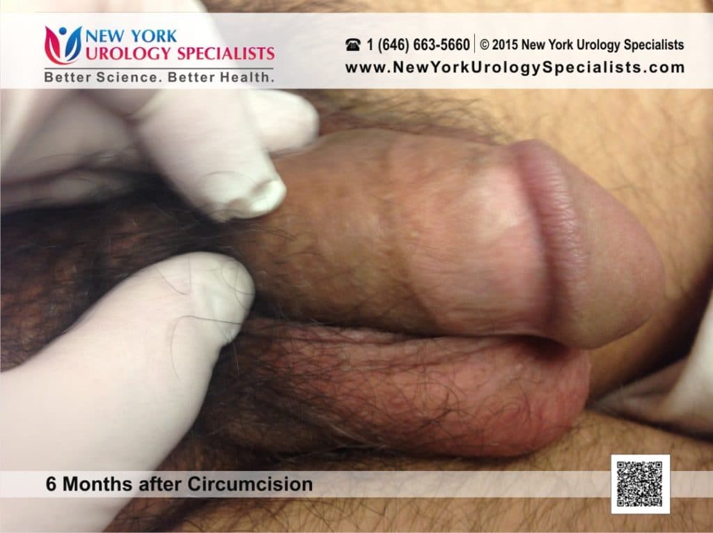 Pictures of Circumcised vs Uncircumcised Male Penis.
