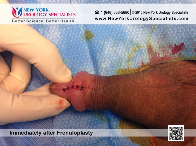 You may also... penile frenuloplasty. at New York Urology Specialists. fren...