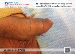 Before Frenulectomy Before Frenulectomy
