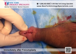 Right After Frenuloplasty Right After Frenuloplasty