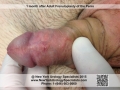 Penis appearance after frenuloplasty (1 month) Penis appearance after frenuloplasty (1 month)