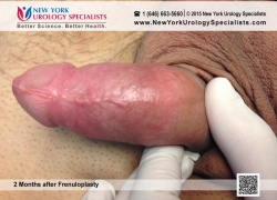 3 weeks after Frenuloplasty 3 weeks after Frenuloplasty