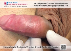 3 weeks after Frenuloplasty 3 weeks after Frenuloplasty