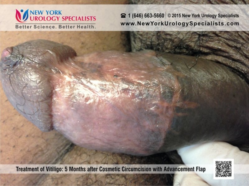 vitiligo pe penis)