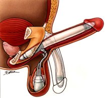 Prótesis de pene