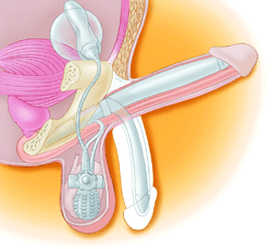 Penile Prosthesis for Treatment of ED