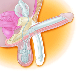 Prótesis de Pene para el Tratamiento de la DE