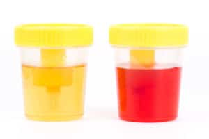 Blood in Urine