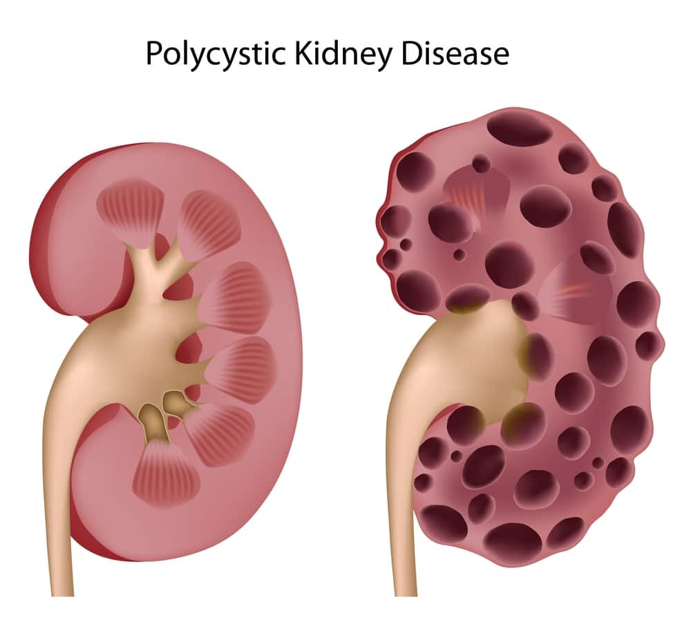Kidney Cysts Kidney Cancer Specialists in NYC