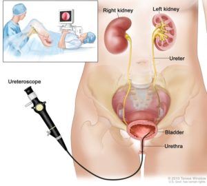 Ureteroscopy for Kidney Stones