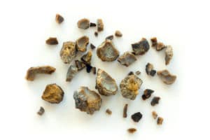 kidney stones