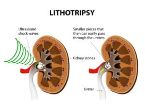 Lithotripsy for 7 mm Ureteral Stone