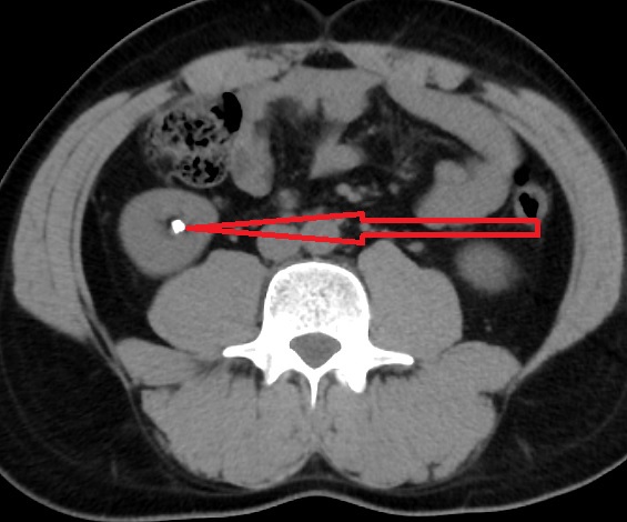 Diagnosis Of Kidney Stones And Ureteral Stones NYC Kidney Stone Clinic diagnosis-of-kidney-stones-and-ureteral-stones-nyc-kidney-stone-clinic