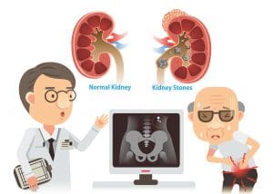 Kidney Stones