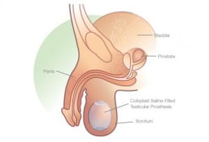 coloplast-testicular-prosthesis