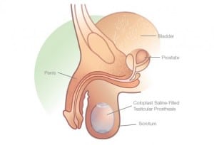 prótesis-testicular-coloplast