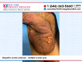 Idiopathic scrotal calcinosis multiple scrotal cysts