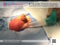 Wound Irrigation - Testicular Implant