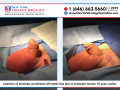 Insertion of testicular prosthesis left testis lost due to testicular torsion 15 years earlier
