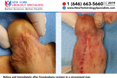 Before and immediately after frenuloplasty revision in a circumcised man