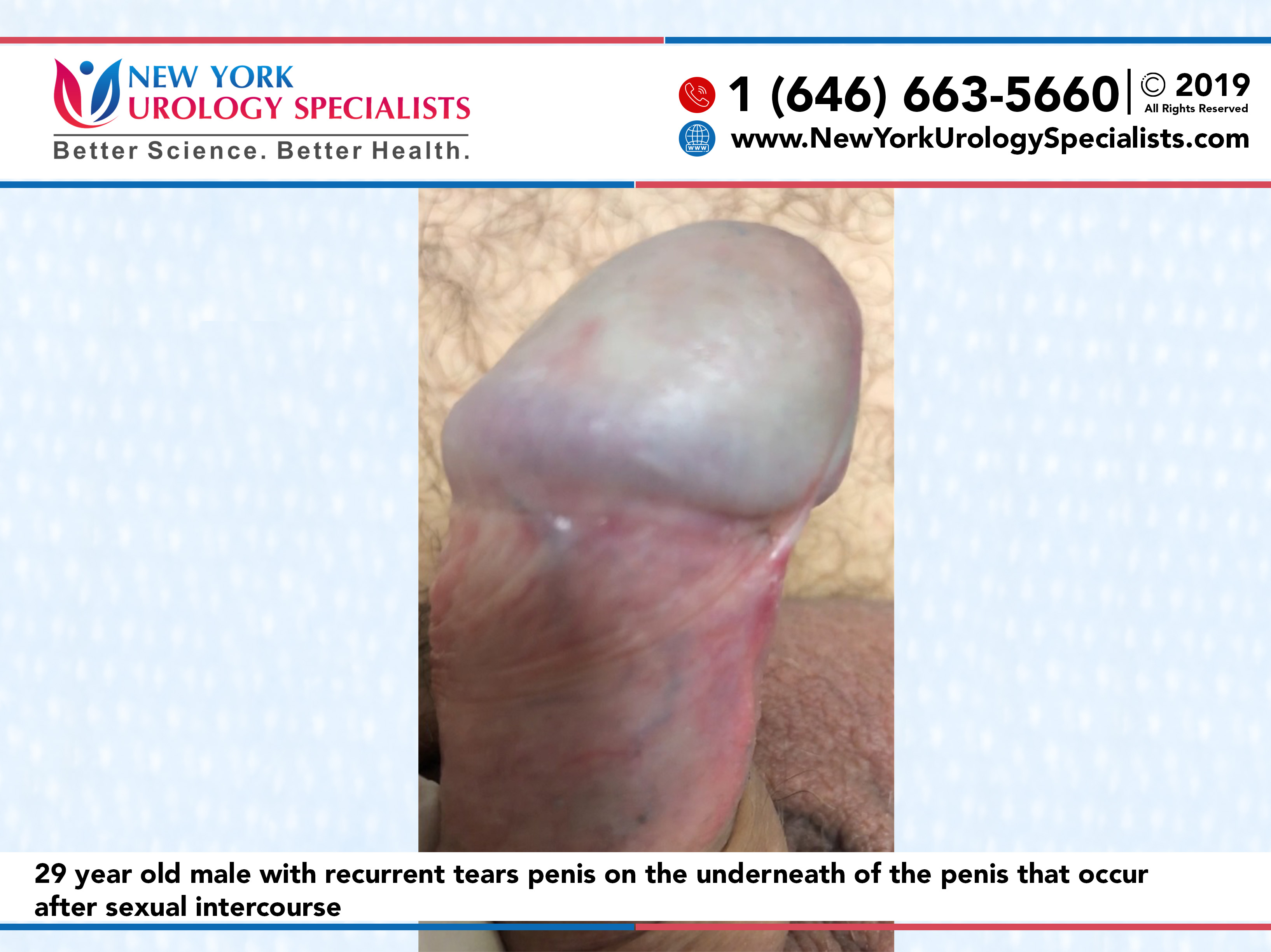 Galería de Fotos de Frenillo Breve: Álbum de Fotos del Antes y Después de  la Frenuloplastia - Penis Wellness Center of North America in NYC