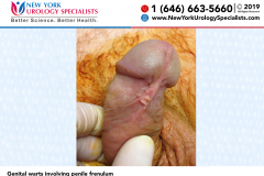 20150407_203126898_iOS_Genital-warts-involving-penile-frenulum