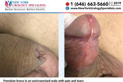 3238and3240_Frenulum-breve-in-an-uncircumcised-male-with-pain-and-tears 3238and3240_Frenulum-breve-in-an-uncircumcised-male-with-pain-and-tears