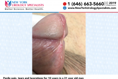 3243_Penile-pain-tears-and-lacerations-for-10-years-in-a-31-year-old-man 3243_Penile-pain-tears-and-lacerations-for-10-years-in-a-31-year-old-man