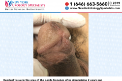 3329_Residual-tissue-in-the-area-of-the-penile-frenulum-after-circumcision-2-years-ago 3329_Residual-tissue-in-the-area-of-the-penile-frenulum-after-circumcision-2-years-ago