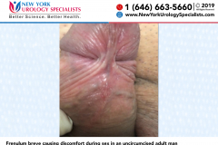 4932a_Frenulum-breve-causing-discomfort-during-sex-in-an-uncircumcised-adult-man 4932a_Frenulum-breve-causing-discomfort-during-sex-in-an-uncircumcised-adult-man