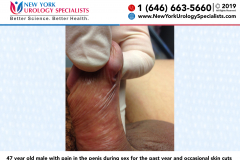 4938_47-year-old-male-with-pain-in-the-penis-during-sex-for-the-past-year-and-occasional-skin-cuts 4938_47-year-old-male-with-pain-in-the-penis-during-sex-for-the-past-year-and-occasional-skin-cuts