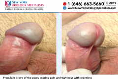 5751and5755_Frenulum-breve-of-the-penis-causing-pain-and-tightness-with-erections 5751and5755_Frenulum-breve-of-the-penis-causing-pain-and-tightness-with-erections