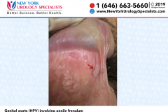 6275a_Genital-warts-HPV-involving-penile-frenulum 6275a_Genital-warts-HPV-involving-penile-frenulum
